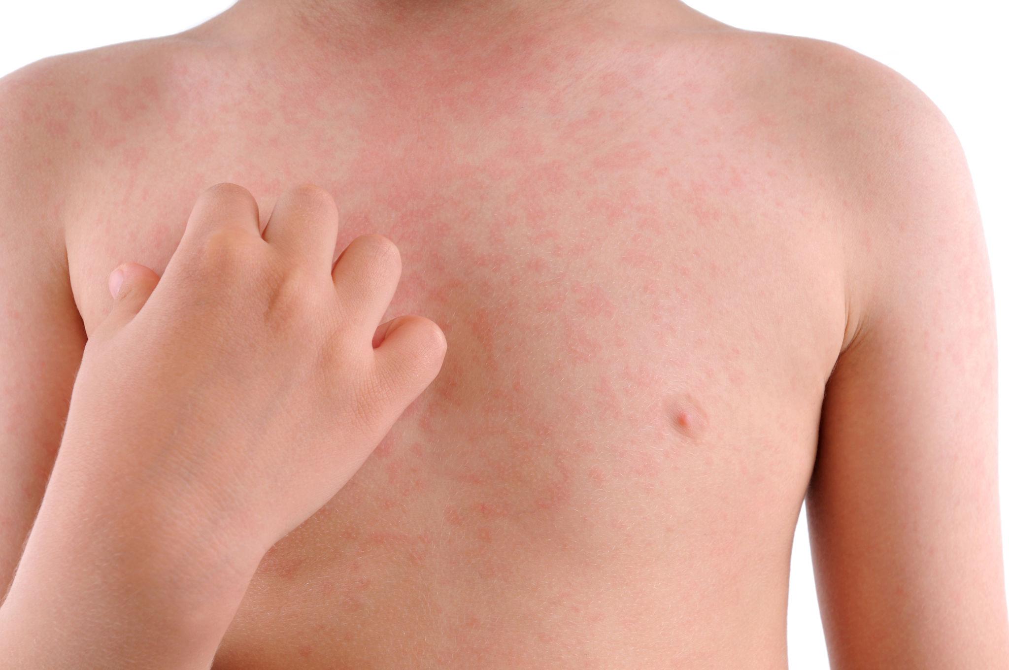 Hives Symptoms in Children: What It Looks Like and When to Worry