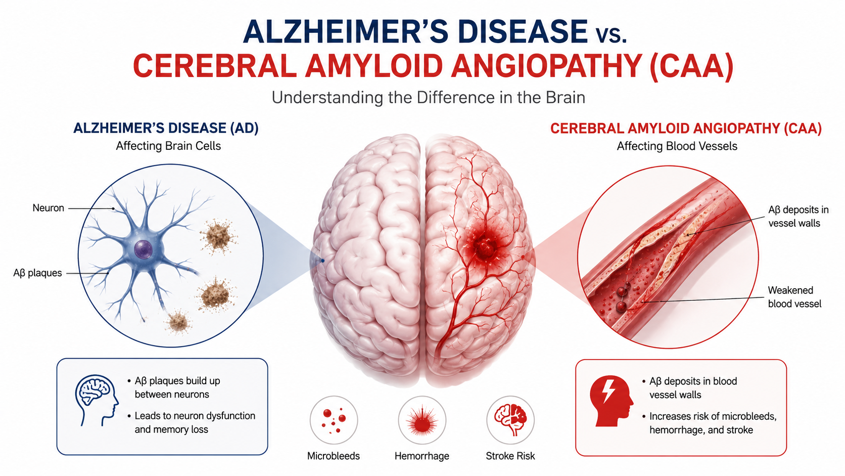 Cerebral Amyloid Angiopathy is a disease of the blood vessels located ...