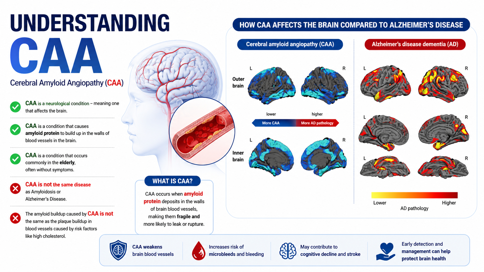 Cerebral Amyloid Angiopathy (CAA): A Clear Guide to Symptoms, Risks ...
