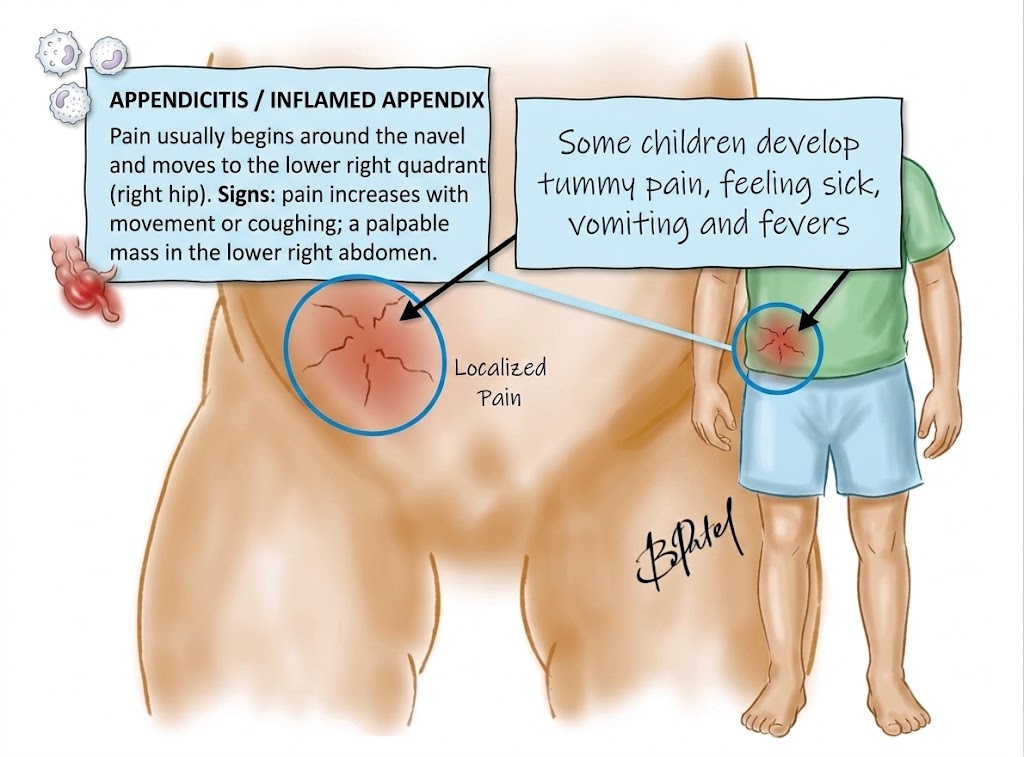Appendicitis Symptoms in Kids: A Parent’s Guide to Warning Signs