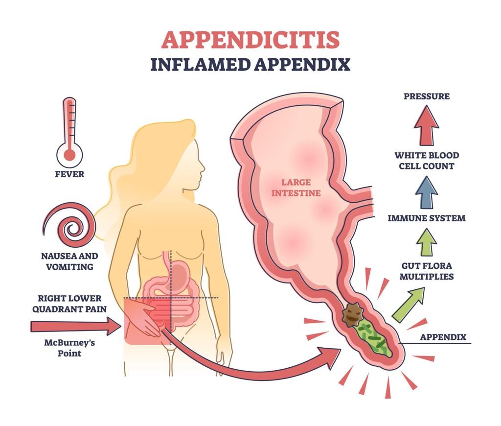 Appendicitis vs Appendix Cancer: Symptoms Explained