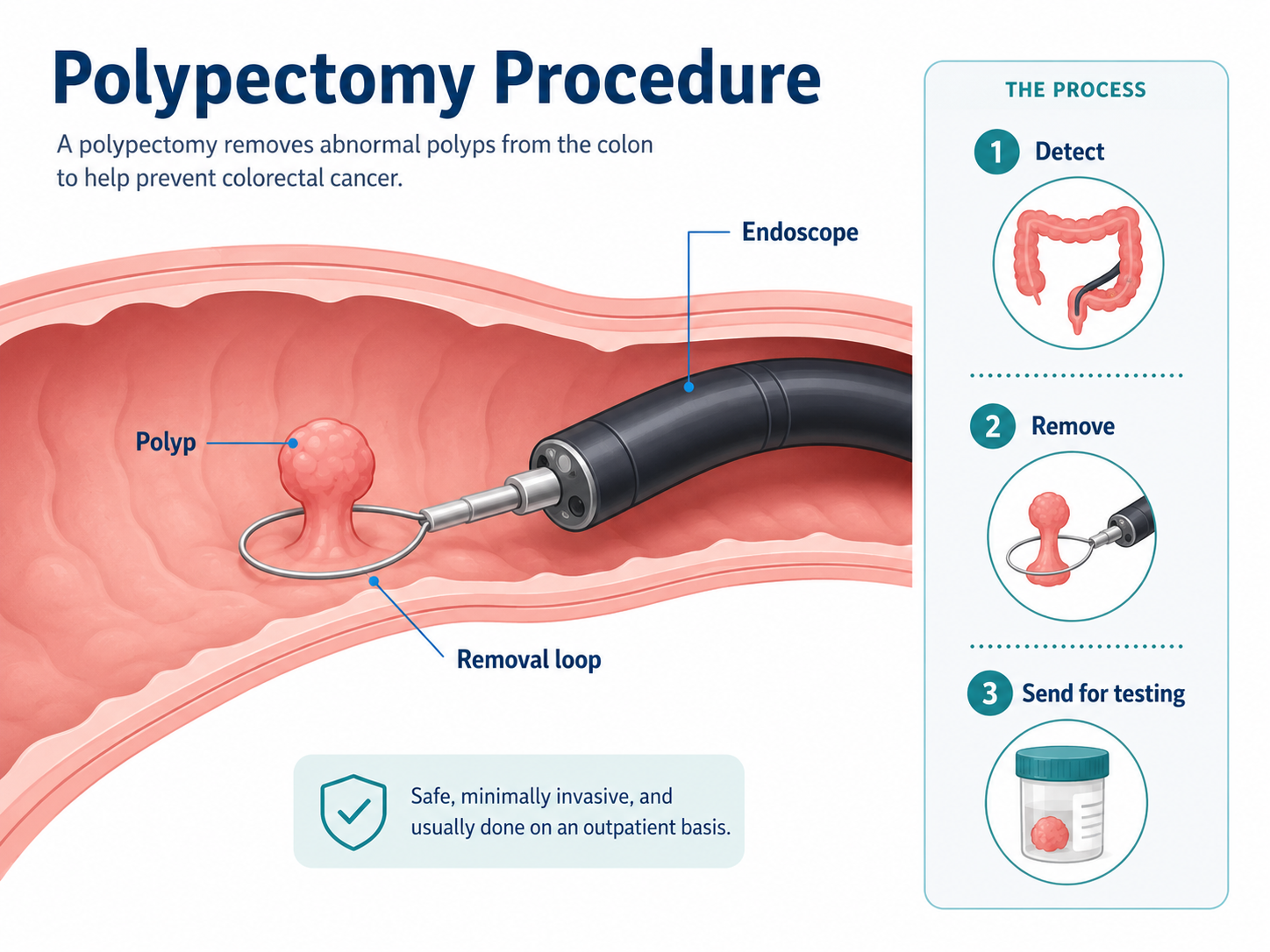 Polypectomy Procedure: Types, Preparation, Recovery, Risks, and Results