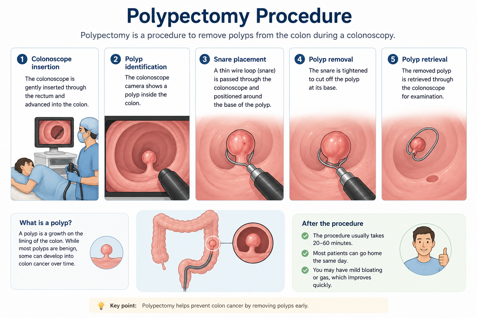 Polypectomy Procedure: Types, Preparation, Recovery, Risks, and Results
